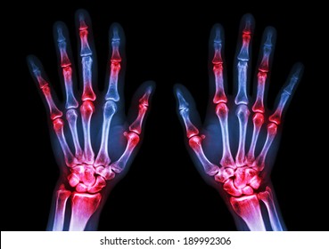 film x-ray both human's hands and arthritis at multiple joint (Gout,Rheumatoid)