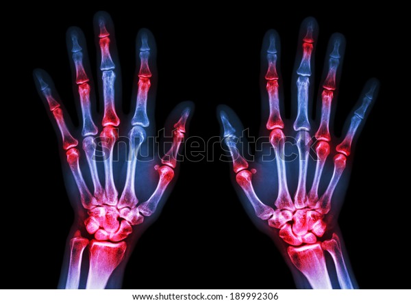 film x-ray both human's hands and
arthritis at multiple joint
(Gout,Rheumatoid)