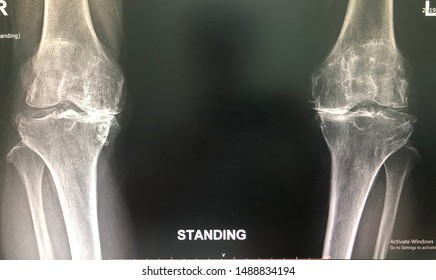 Film X-ray Both Knee AP In Osteoarthritis Of Both Knee