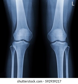 Film x-ray both knee joints (AP view)  : show normal human's both knee joints