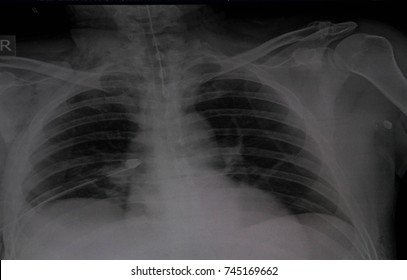 Film X-Ray Chest Right Intercostals Drainage (ICD)and ET.Tube