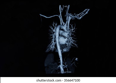 Film X-ray Ct Angiogram 3D Take Photo From Film