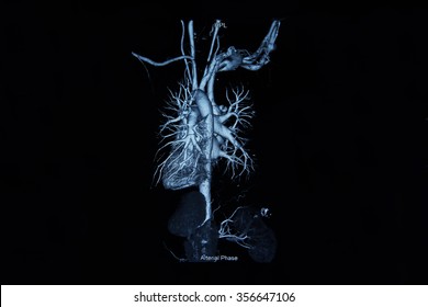 Film X-ray Ct Angiogram 3D Take Photo From Film