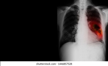 Film x-ray (CXR) show lung mass with clear copy space. Lung cancer or carcinoma is malignant tumor which can spread (metastasis). Treatment as surgery, chemotherapy or radiation. Oncology concept