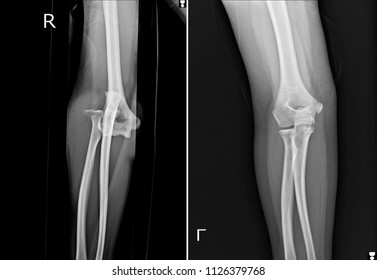 Film Xray  Elbow AP Showed Fracture Left Of Elbow And Dislocation Right Of Elbow .medical Image.