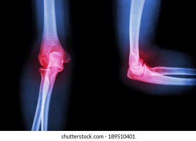 Film Xray Elbow Arthritis Rheumatoidgout Stock Photo Shutterstock