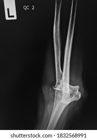 Radiography Tibia Lateral Projection Tibial Fracture Foto Stok