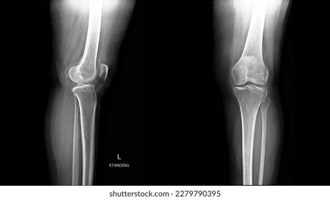 Film X-ray examination of LT knee AP and Lateral view. Old Asian woman. Anatomy of the knee. standard projection to assess the knee joint, distal femur, proximal tibia and fibula and the patella.