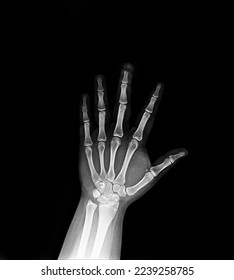 film x-ray  finger of fracture  - Shutterstock ID 2239258785