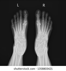 Film Xray Foot 