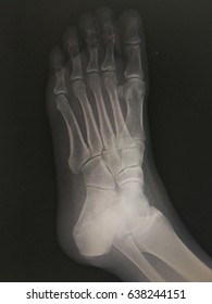 Film Xray Foot Stock Photo 638244151 | Shutterstock