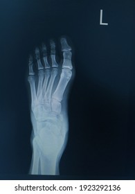 Film x-ray foot lateral views Finding fracture navicular bone and soft tissure swelling,Medical image concept.