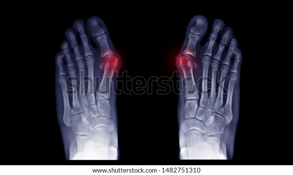 Film X-ray foot radiograph show both Hallux\
valgus deformity or Bunion disease. The patient has big toe pain\
symptom ,shoe wearing and cosmetic problem. Highlight on painful\
area. Medical concept