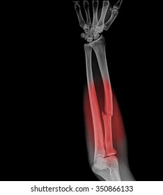 Film Xray Forearm Ap Show Fracture Stock Photo 350866133 | Shutterstock