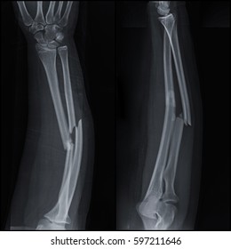 Fracture Shaft Radius Ulnar Bone Xray Stock Photo 379972036 | Shutterstock