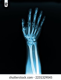 film  X-ray hand and finger  - Shutterstock ID 2231329045