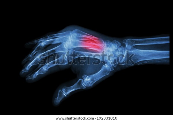 Film Xray Hand Oblique Fracture 3rd Stock Photo 192331010 | Shutterstock