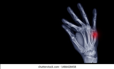 Film X-ray hand radiograph show hand bone broken (fifth metacarpal fracture or Boxer's fracture) from traffic accident. Highlight on fracture site and painful area. Medical imaging concept 