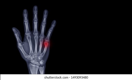 Film Xray Hand Radiograph Show Finger Stock Photo (Edit Now) 1493093480