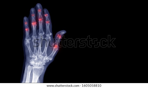 Film Xray Hand Radiography Show Degenerative Stock Photo 1605058810 ...