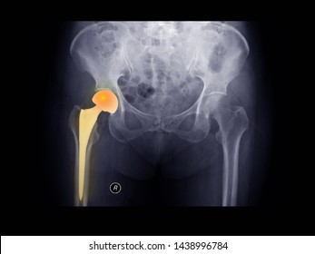 Film X-ray Hip Radiograph Show Right Hip Bone Broken (femur Fracture) Treated By Hip Replacement Surgery (hemiarthroplasty). Highlight On Prosthetic Device. The Left Hip Show Normal Bone.