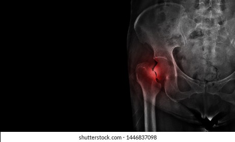 Film X-ray Hip Radiograph Show Broken Hip Bone ( Neck Of Femur Fracture ) With Free Copy Space. Elderly Patient Has Osteoporosis And Accidental Fall At Home. Nursing Care And Fall Prevention Concept. 