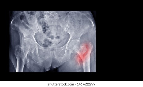 Film X-ray Hip Radiograph Show Broken Hip Bone (intertrochanteric Fracture Of Femur). Elderly Patient Has Osteoporosis And Accidental Fall At Home. Nursing Care And Fall Prevention Concept.