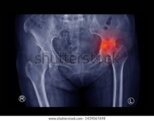 Film Xray Hip Radiograph Show Femoral 庫存照片 立刻編輯 1439067698