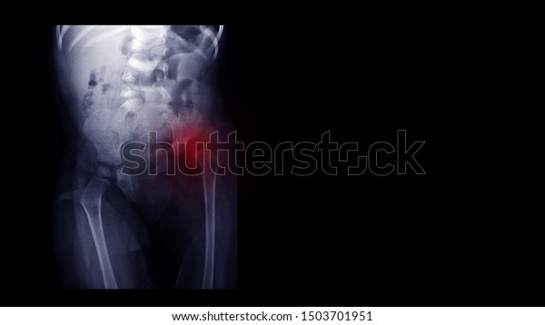 Film X-ray hip radiograph show congenital\
developmental dysplasia of left hip(DDH) disease. Highlight on\
painful area. The patient has hip pain, limping and walking\
problem. Rare medical image\
concept