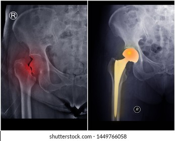 
Film X-ray Hip Radiograph Showing Broken Bone (fracture Neck Of Femur Part) Treated By Hip Replacement Surgery (bipolar Hemiarthroplasty). Medical Technology And Fall Prevention Concept.