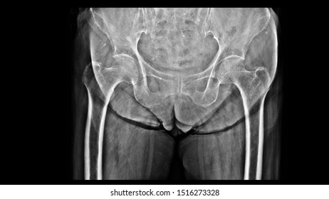 Film X-ray Hip Show Osteoporosis Bone. The Elderly Patient Has Osteoporosis Disease That Loss Bone Density, Weaken Bone Strength And Increase Risk Of Broken. Fall Prevention And Precaution Concept. 