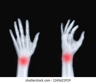 Film Xray Human Hand Showing Wrist Stock Photo (Edit Now) 1245621919