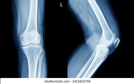  Film x-ray human's knee joints                             