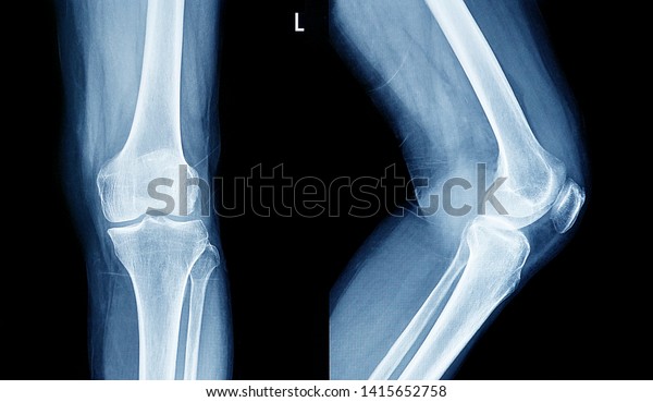  Film x-ray human\'s knee joints                         \
   