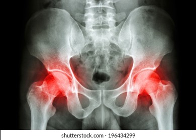 Film X-ray Human's Pelvis And Arthritis At Both Hip Joint (Gout , Rheumatoid)