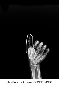 film x-ray index finger and aluminum splint ( point a finger ) - Shutterstock ID 2233234205