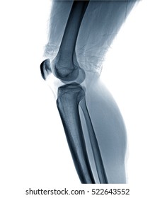 Film x-ray knee AP/lateral : Osteoarthritis knee (Inflammation at knee) , side view , isolate on white background