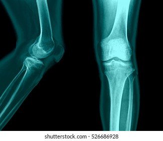 Film x-ray knee AP/lateral : Osteoarthritis knee 