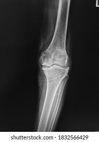 Film X-ray  Knee With Arthritis Of Knee Joint Narrow Knee Joint Space 