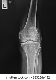 Film X-ray  Knee With Arthritis Of Knee Joint Narrow Knee Joint Space 