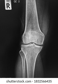 Film X-ray  Knee With Arthritis Of Knee Joint Narrow Knee Joint Space 