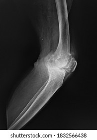 Film X-ray  Knee With Arthritis Of Knee Joint Narrow Knee Joint Space 