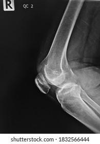 Film X-ray  Knee With Arthritis Of Knee Joint Narrow Knee Joint Space 