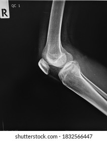 Film X-ray  Knee With Arthritis Of Knee Joint Narrow Knee Joint Space 