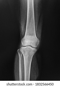 Film X-ray  Knee With Arthritis Of Knee Joint Narrow Knee Joint Space 