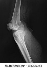 Film X-ray  Knee With Arthritis Of Knee Joint Narrow Knee Joint Space 