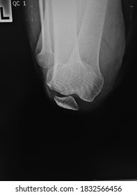 Film X-ray  Knee With Arthritis Of Knee Joint Narrow Knee Joint Space 