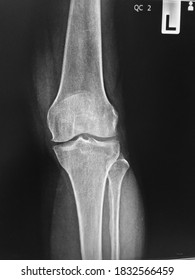 Film X-ray  Knee With Arthritis Of Knee Joint Narrow Knee Joint Space 