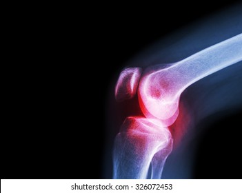 Film x-ray knee joint with arthritis ( Gout , Rheumatoid arthritis , Septic arthritis , Osteoarthritis knee ) and blank area at left side