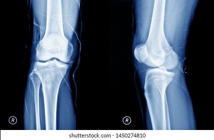 Film x-ray knee joints , human knee joints                               